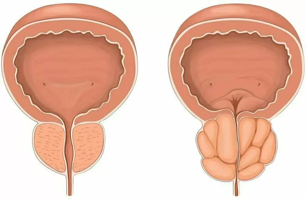 prostata normala eta prostatako gaixoa